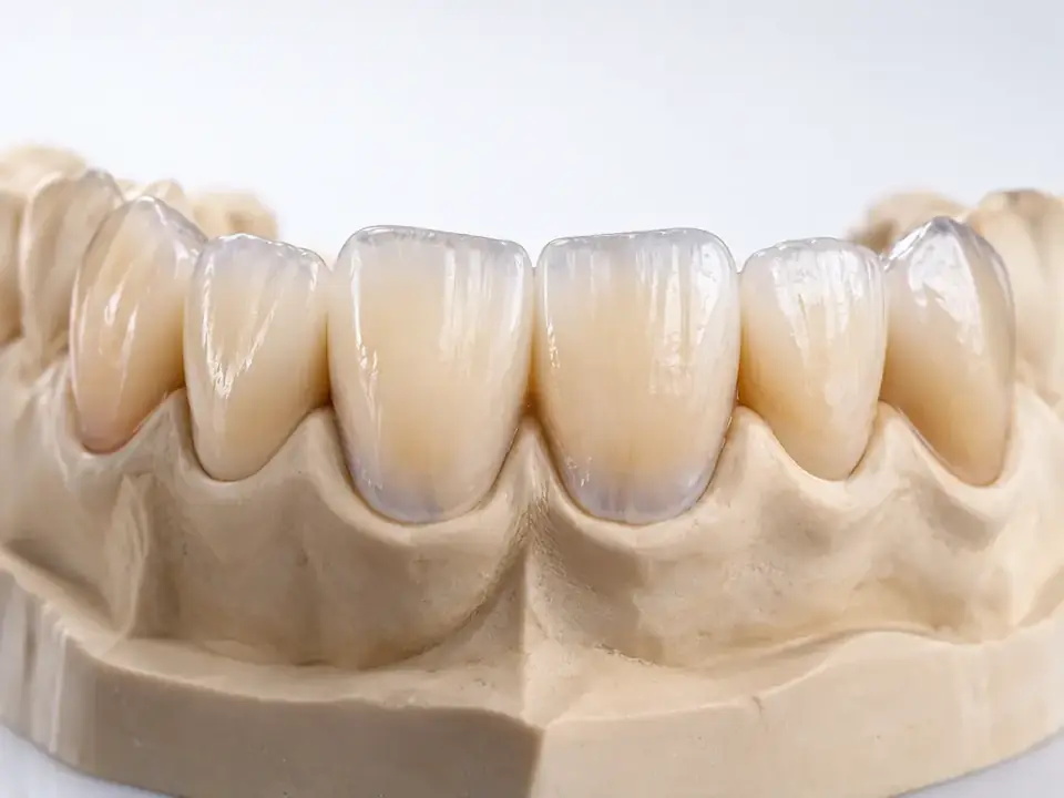 Anterior ceramic restorations