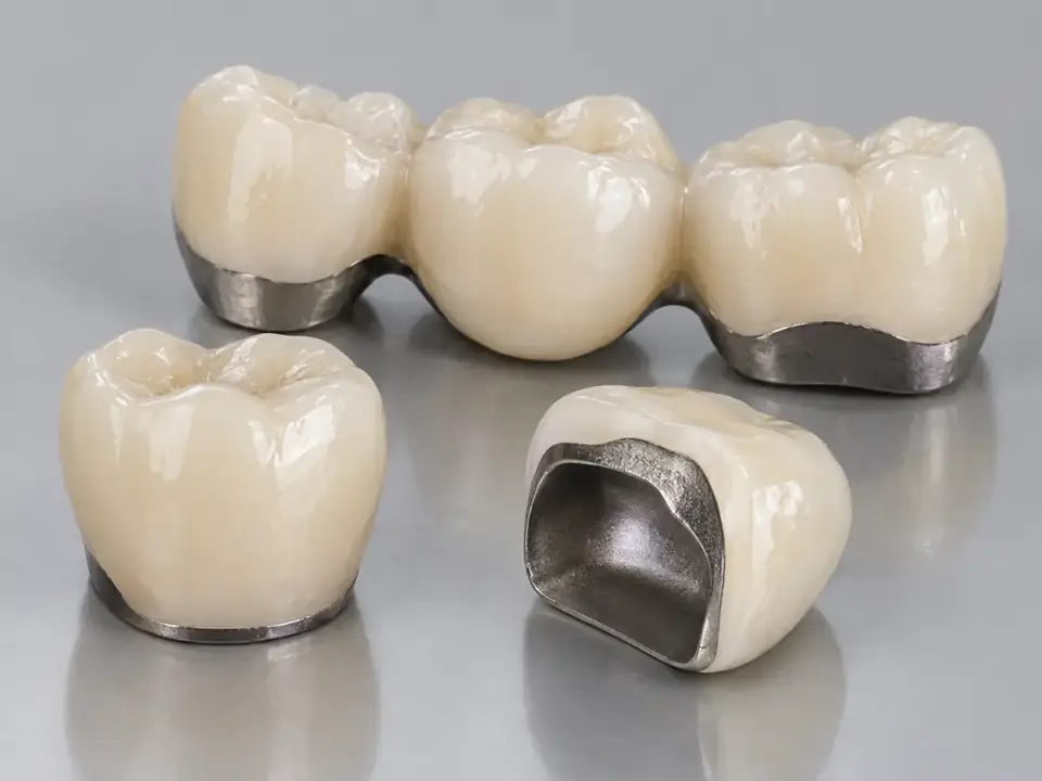 PFM bridge and crowns overview